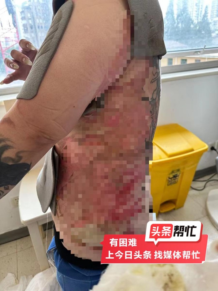 晨意幫忙丨上海女子拔火罐被燙傷需移植豬皮SPA會(huì)所：剛開業(yè)比較困難會(huì)湊手術(shù)費(fèi)