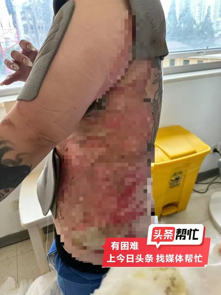 上海一女子拔火罐被燙傷需移植豬皮SPA會所拒付手術費引發爭議
