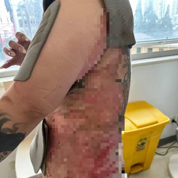 上海一女子拔火罐被燙傷需移植豬皮SPA會所拒付手術費引發爭議