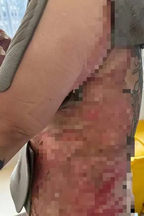 上海一女子拔火罐被燙傷需移植豬皮SPA會所拒付手術費引發爭議