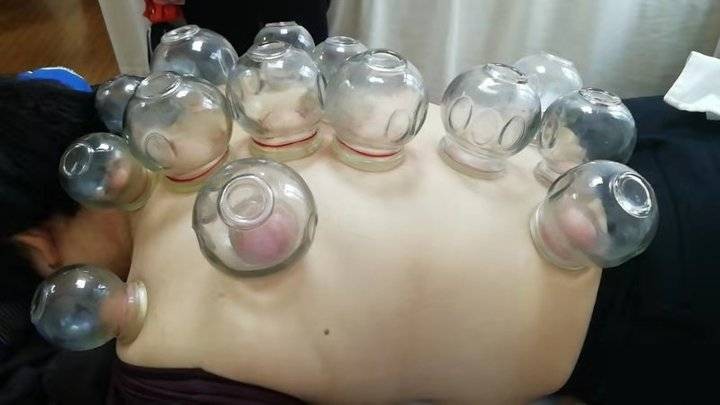 女演員SPA店拔火罐燒傷!省中醫專家:拔罐雖好這些人不適合