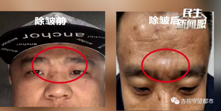 哥倆一心搞事業到長春幸福街纖手美容spa會所去川字紋結果卻變成了大包