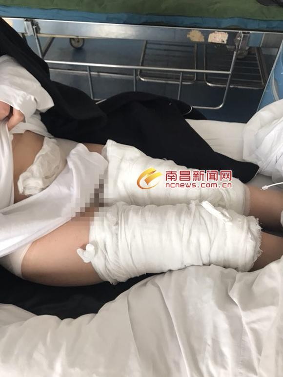 無證美容店忽悠顧客火療變成火烤活人