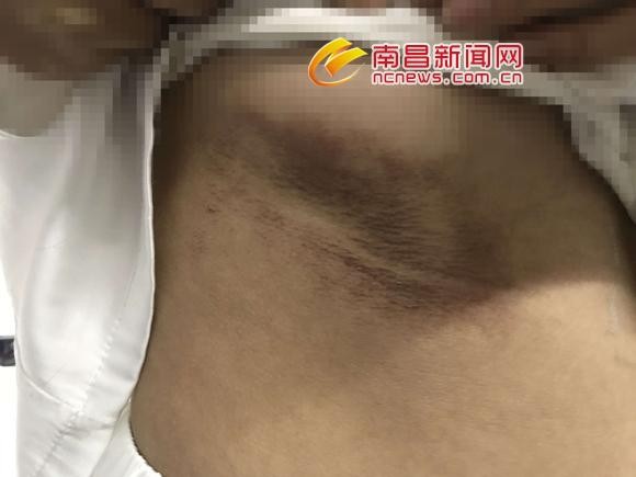 無證美容店忽悠顧客火療變成火烤活人