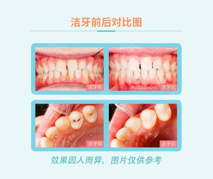 睡眠洗牙｜洗牙黑科技來給牙齒做個SPA